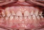 Colocação de uma coroa de zircónia pré formada num molar temporário de um paciente não colaborador