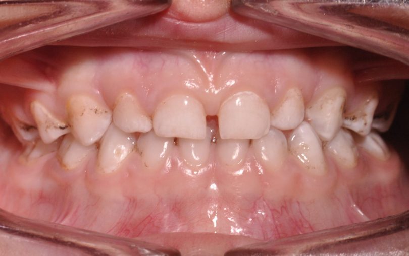 Colocação de uma coroa de zircónia pré formada num molar temporário de um paciente não colaborador