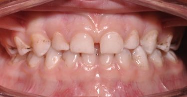 Colocação de uma coroa de zircónia pré formada num molar temporário de um paciente não colaborador