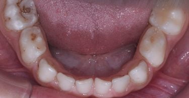 Colocação de uma coroa de zircónia pré formada num molar temporário de um paciente não colaborador