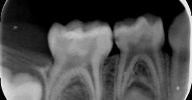 Colocação de uma coroa de zircónia pré formada num molar temporário de um paciente não colaborador