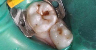 Colocação de uma coroa de zircónia pré formada num molar temporário de um paciente não colaborador