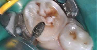 Colocação de uma coroa de zircónia pré formada num molar temporário de um paciente não colaborador