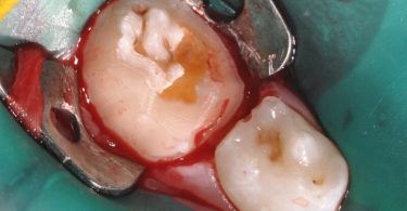 Colocação de uma coroa de zircónia pré formada num molar temporário de um paciente não colaborador