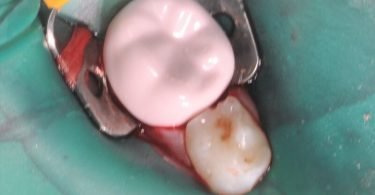 Colocação de uma coroa de zircónia pré formada num molar temporário de um paciente não colaborador