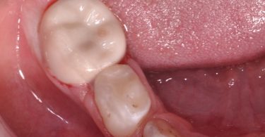 Colocação de uma coroa de zircónia pré formada num molar temporário de um paciente não colaborador