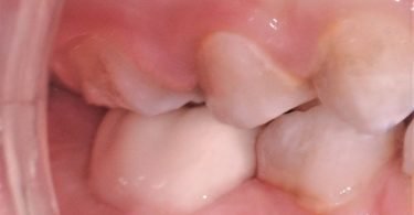 Colocação de uma coroa de zircónia pré formada num molar temporário de um paciente não colaborador