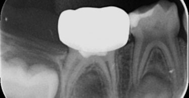 Colocação de uma coroa de zircónia pré formada num molar temporário de um paciente não colaborador