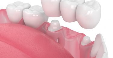 Vet Atual implantes ceramicos