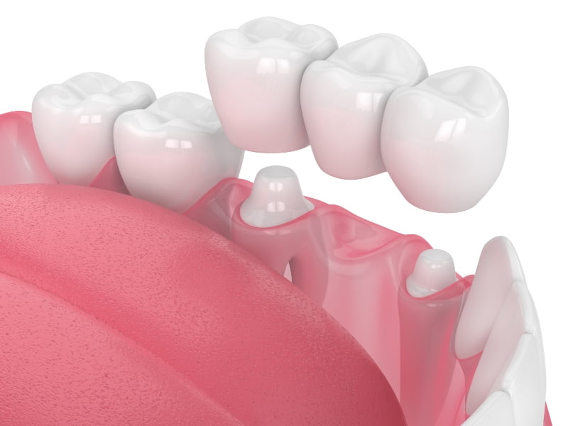 Vet Atual implantes ceramicos