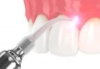 Academia Biolase anuncia formação online sobre laser dental