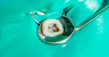 Investigadores brasileiros criam composto natural para tratamento dos dentes