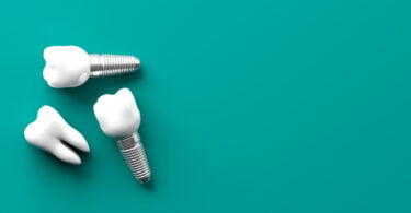 Investigadores implantes dentários