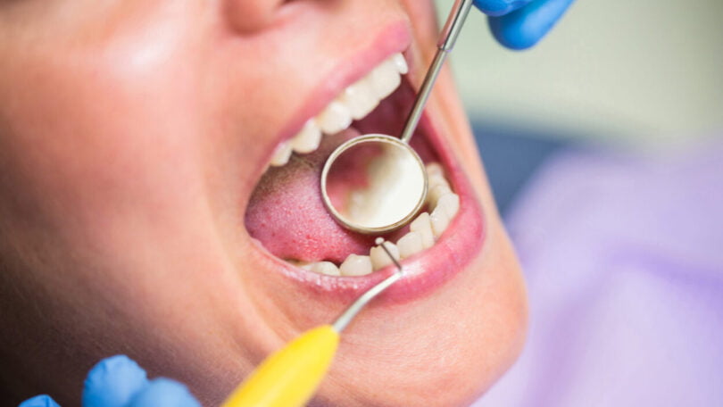 Lembre três complicações que podem começar na saúde oral 