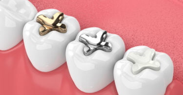 Aumentar durabilidade de obturações dentárias é o objetivo de um novo projeto alemão