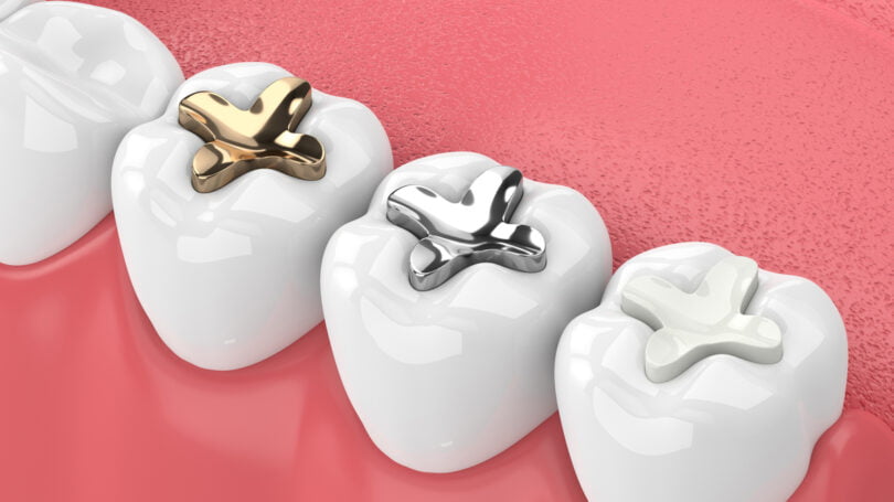 Aumentar durabilidade de obturações dentárias é o objetivo de um novo projeto alemão