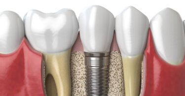 O ITI Study Club – Oporto 3 está a organizar um evento com o tema “Quanto osso realmente necessitamos em torno dos nossos implantes?”.