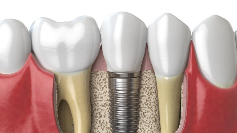 O ITI Study Club – Oporto 3 está a organizar um evento com o tema “Quanto osso realmente necessitamos em torno dos nossos implantes?”.