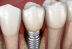 Um estudo desenvolveu um algoritmo que poderá ajudar a prever os riscos dos pacientes com implantes de desenvolverem peri-implantite.