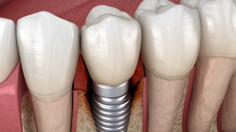 Um estudo desenvolveu um algoritmo que poderá ajudar a prever os riscos dos pacientes com implantes de desenvolverem peri-implantite.