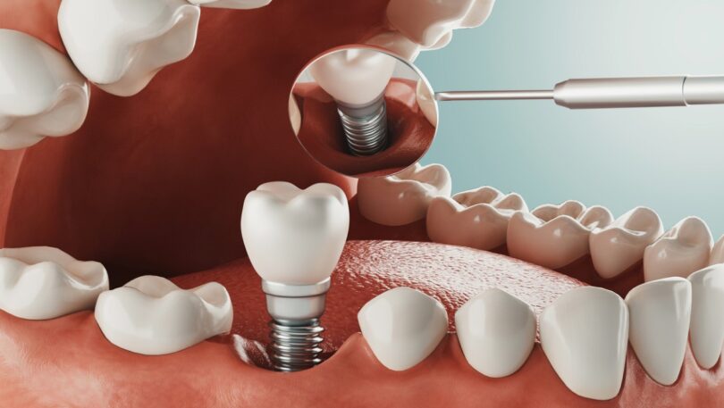 Investigadores tentaram perceber qual é a visão dos médicos dentistas suecos e finlandeses acerca do uso de coroas em aço inoxidável.
