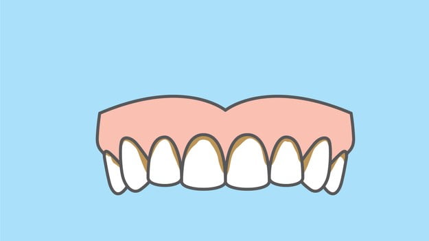 Um estudo brasileiro descobriu a presença do vírus SARS-CoV-2 no biofilme dentário de pacientes que testaram positivo para a covid-19.