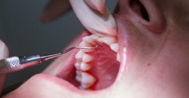 Investigadores da Faculdade de Medicina Dentária da Universidade de Washington identificaram um terceiro fenótipo de inflamação oral.