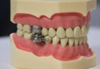 Investigadores do Reino Unido e da Universidade de Otago, na Nova Zelândia, desenvolveram um cadeado intraoral, o Dental Slim Diet Control.