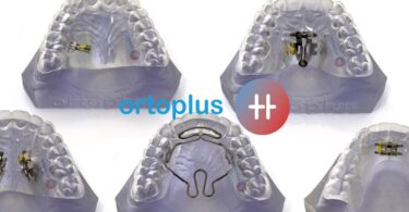 A Ortoplus lançou uma nova técnica Hybrid (TH) para diminuir o tempo dos tratamentos de ortodontia invisível.
