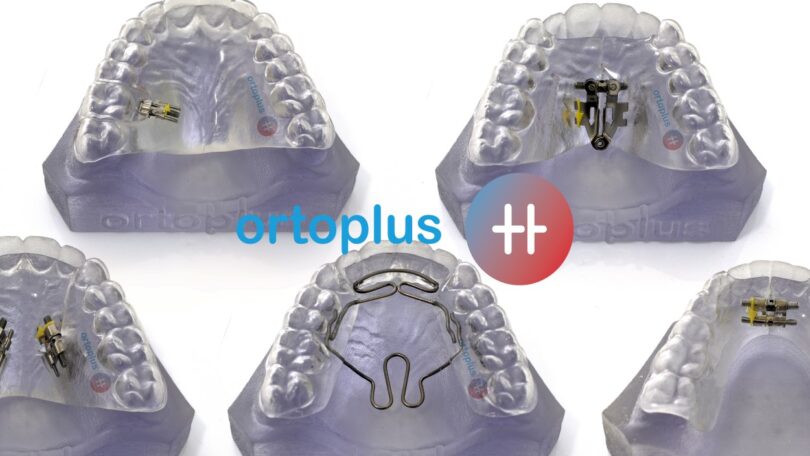 A Ortoplus lançou uma nova técnica Hybrid (TH) para diminuir o tempo dos tratamentos de ortodontia invisível.