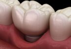 Um estudo analisou a prevalência e o risco de doenças como a mucosite dependendo do tipo de prótese colocada ao lado do implante dentário.
