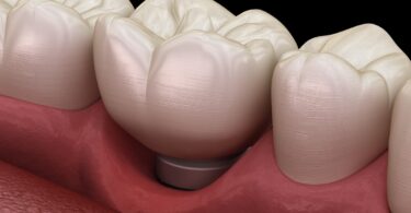 Um estudo analisou a prevalência e o risco de doenças como a mucosite dependendo do tipo de prótese colocada ao lado do implante dentário.