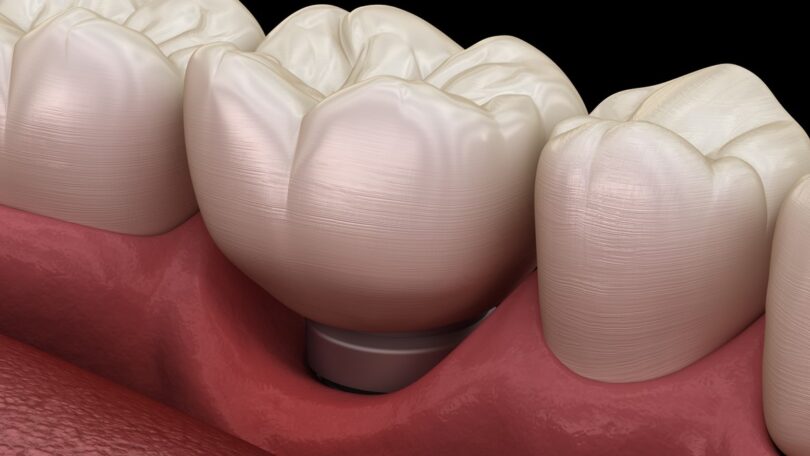 Um estudo analisou a prevalência e o risco de doenças como a mucosite dependendo do tipo de prótese colocada ao lado do implante dentário.