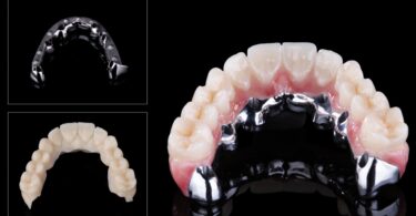A Zirkonzahn anunciou uma barra, a Bartplatte, que permite realizar restaurações aparafusadas sobre implantes angulados.