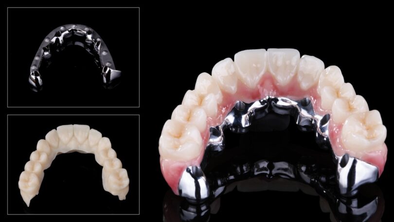A Zirkonzahn anunciou uma barra, a Bartplatte, que permite realizar restaurações aparafusadas sobre implantes angulados.