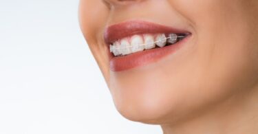 As diferenças entre os processos de remoção de brackets