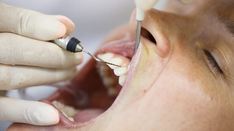 Prevalência de microrganismos resistentes pode colocar em risco tratamentos periodontais