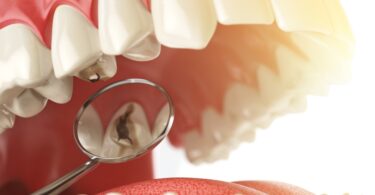 Universidade das Ilhas Baleares está a estudar gestão de cáries dentárias