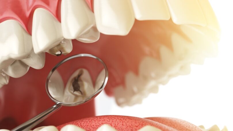 Universidade das Ilhas Baleares está a estudar gestão de cáries dentárias