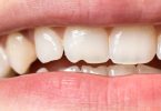 Diabetes reduz força e durabilidade do esmalte e da dentina