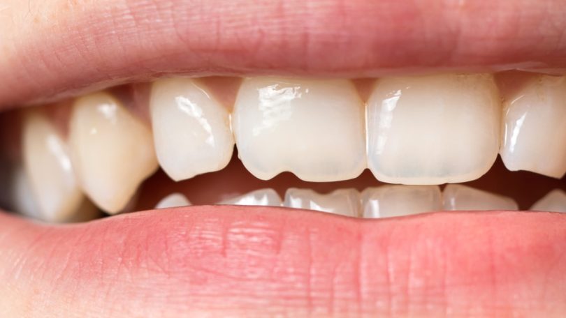 Diabetes reduz força e durabilidade do esmalte e da dentina