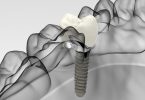 Nobel Biocare Symposium regressa inserido no Envista Summit