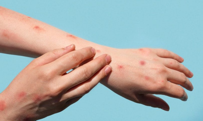 A importância dos profissionais de medicina dentária na deteção de casos de monkeypox