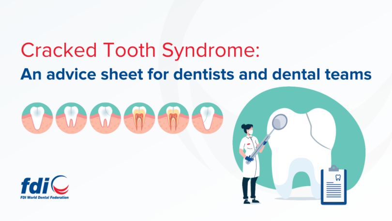 FDI lança advice sheet sobre síndrome do dente fissurado