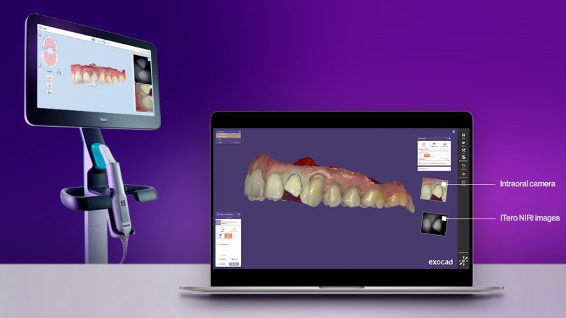 Align Technology integra câmara intraoral e imagens NIRI no iTero-Exocad Connector