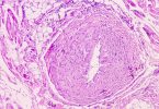 Casos de cancro oral no Reino Unido atingem recorde