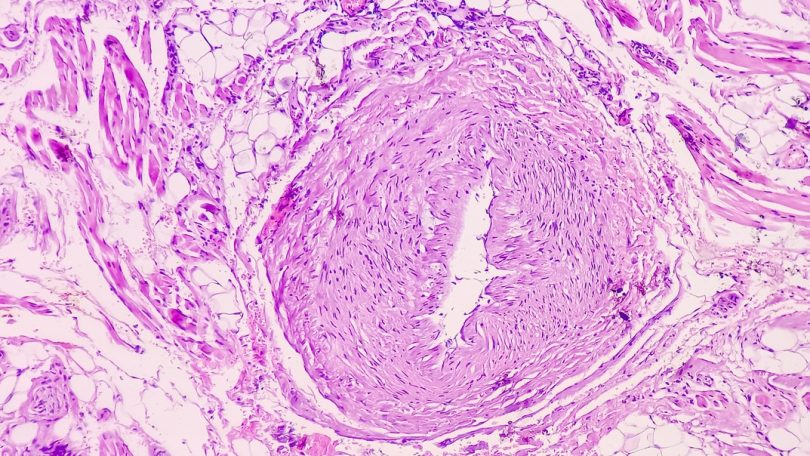 Casos de cancro oral no Reino Unido atingem recorde